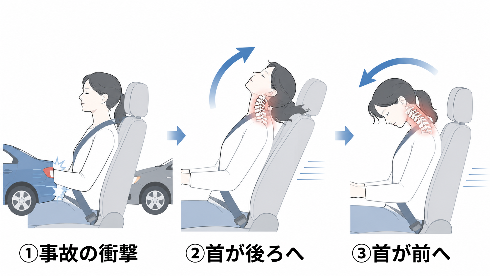 交通事故でむち打ちが起こる仕組みの図解